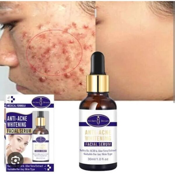Aichun Beauty Medical Formula Anti-Acne Whitening Facial Serum-30ML