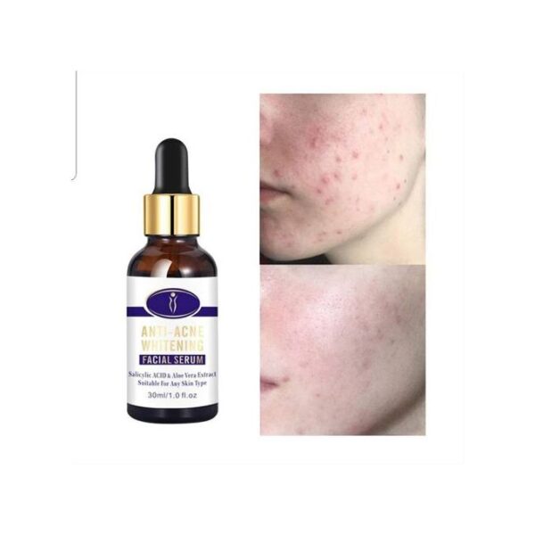 Aichun Beauty Medical Formula Anti-Acne Whitening Facial Serum-30ML - Image 6
